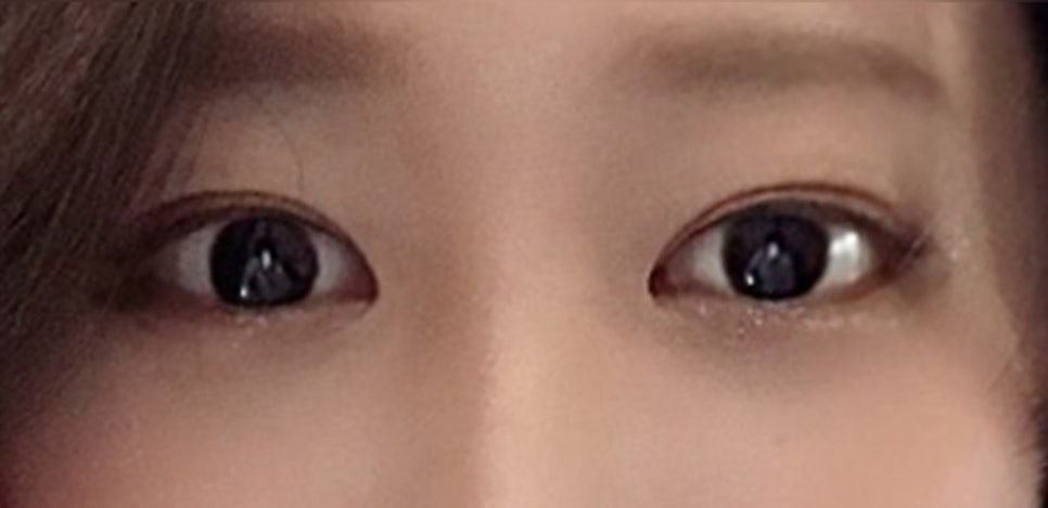 Revision Eyelid Surgery Review (3) Extreme Eyes, Cases of Improvement After Overcorrection in Eyelid Correction image 4