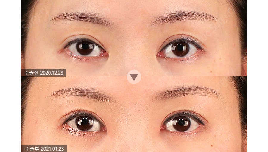 Can the Line Be Changed Because of an Epicanthoplasty Scar? How to Change It to an Outlined, Inline, or In-Out Line image 7