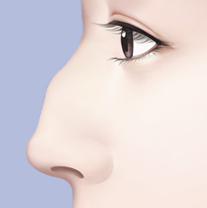 Things to Consider When Thinking About Revision Surgery for a Hump Nose image 2