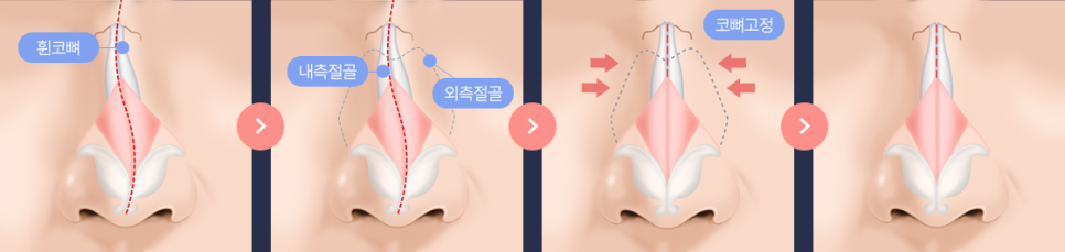 If you are concerned about a crooked nose, consider the degree of deviation, the location, and whether a deviated septum is present image 2