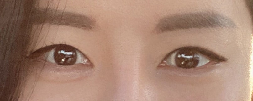 티에스 극한눈 재수술 리뷰(1) 피부부족, 비대칭, 토안증이 심했던 분의 수술전후 변화 관련 이미지 14