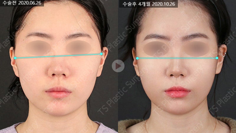 Does Facial Contouring Surgery Always Require All 3 Procedures? Cases Where Zygoma Reduction Surgery Alone Can Create a Smaller, Smoother Face image 7