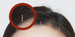 Explore Various Ways to Improve a Drooping Forehead image 3