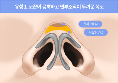If hump nose surgery and alar reduction are performed together, it may help achieve harmonious facial proportions image 1
