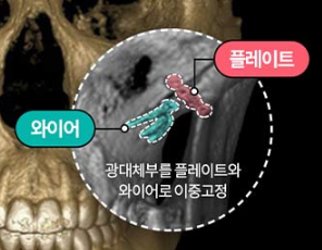 Facial Contouring Surgery for Improving Face Shape: Preparation for the Right Choice image 2