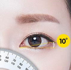 Canthoplasty and Lateral Canthoplasty to Soften the Eyes image 1