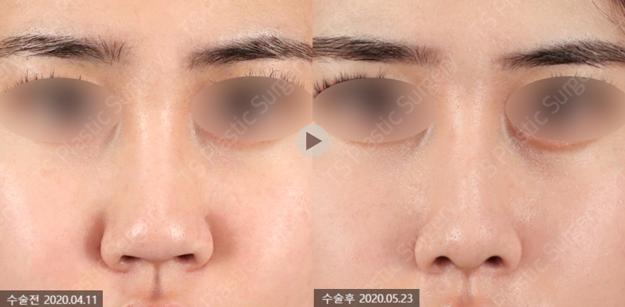 How Can Wide Nostrils Be Corrected? (Effective Bulbous Nose Correction Methods) image 6