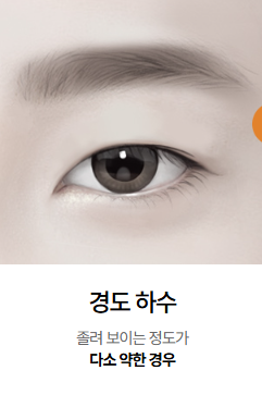 눈재수술 시 눈매교정이 꼭 필요할까? 관련 이미지 1