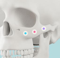Facial Contouring Surgery for Improving Face Shape: Preparation for the Right Choice image 3