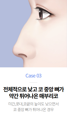 매부리코성형, 매부리 유형에 따라 수술 방향이 달라진다면? 관련 이미지 3