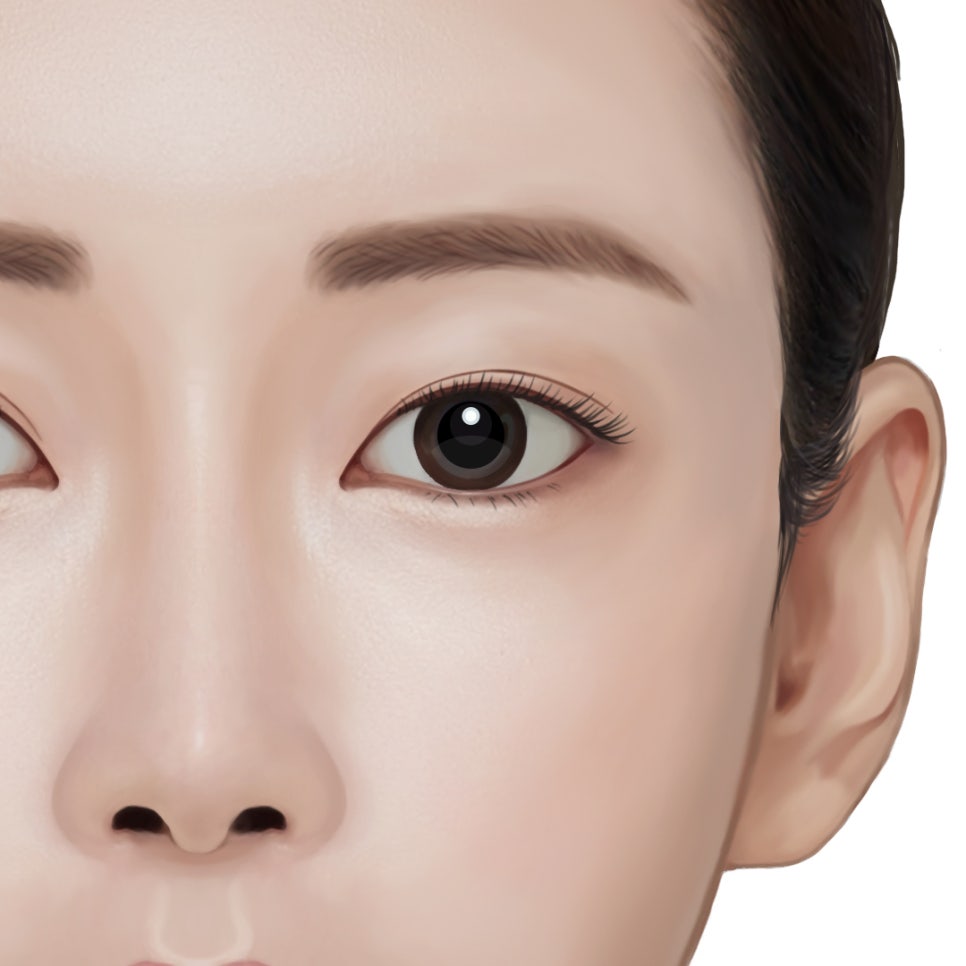 Revision Eye Surgery: Is Correction of Upper Eyelid Retraction in Excessively Open Eyes Really Necessary? image 4