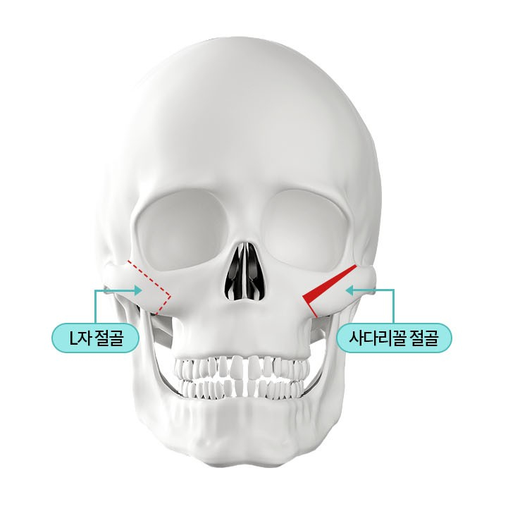Does Facial Contouring Surgery Always Require All 3 Procedures? Cases Where Zygoma Reduction Surgery Alone Can Create a Smaller, Smoother Face image 4