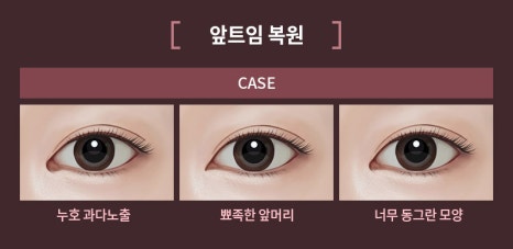 Can the Line Be Changed Because of an Epicanthoplasty Scar? How to Change It to an Outlined, Inline, or In-Out Line image 3