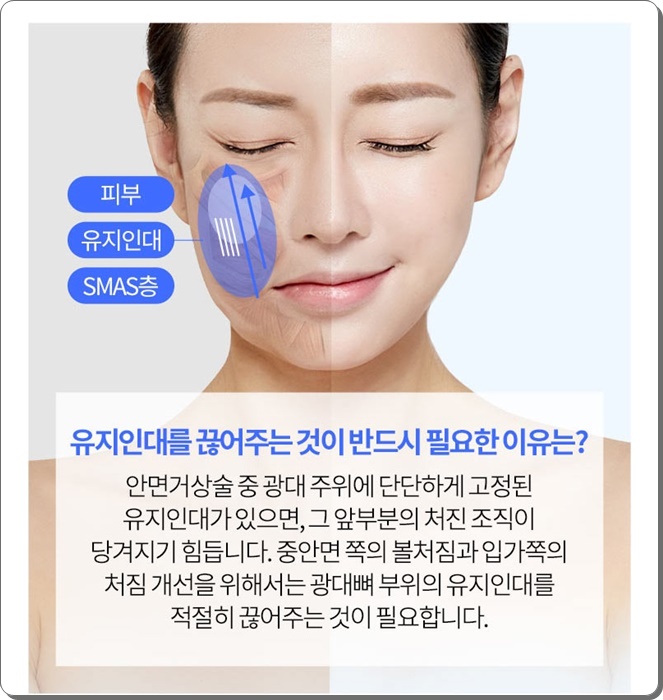 안면거상술의 비밀 그리고 안면거상 할 때 유의할 점이라면 관련 이미지 12