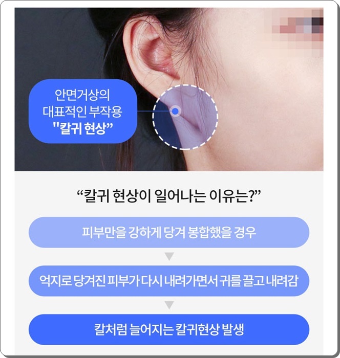 안면거상술의 비밀 그리고 안면거상 할 때 유의할 점이라면 관련 이미지 14
