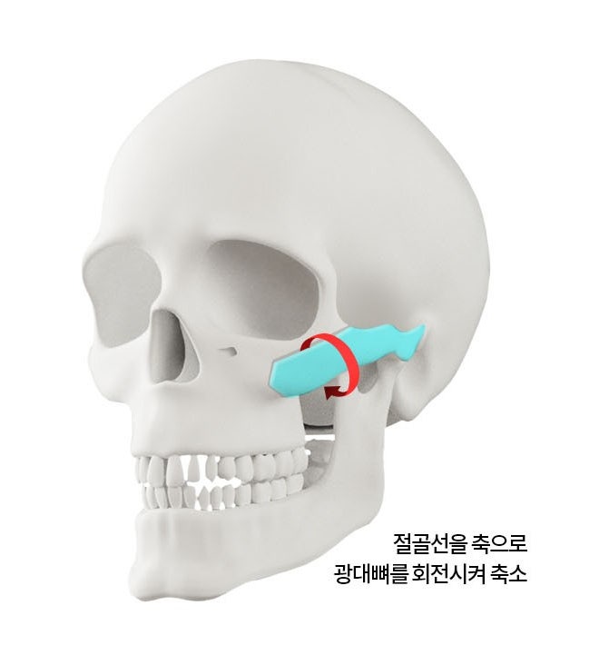 Does Facial Contouring Surgery Always Require All 3 Procedures? Cases Where Zygoma Reduction Surgery Alone Can Create a Smaller, Smoother Face image 6