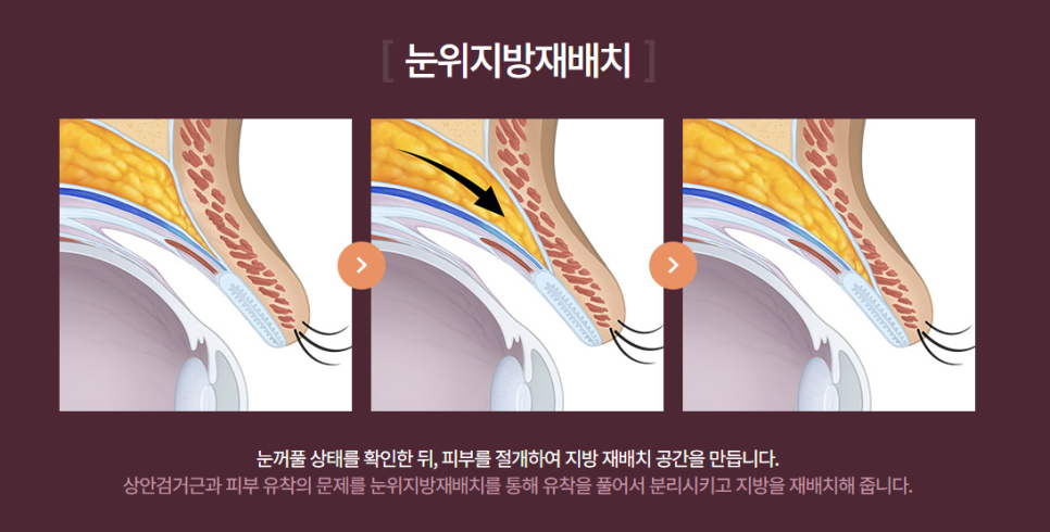 Revision Surgery for Sausage Eyes: How Is It Approached When There Is Not Enough Skin and Tissue? image 2