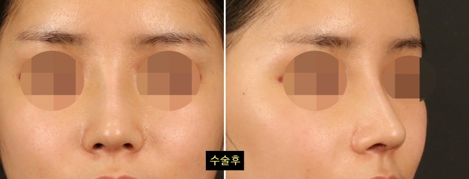 코수술 후 변화가 뚜렷하게 느껴지는 얼굴 유형 4가지 관련 이미지 4