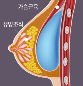 가슴 수술의 주요 과정과 안전한 선택 관련 이미지 2