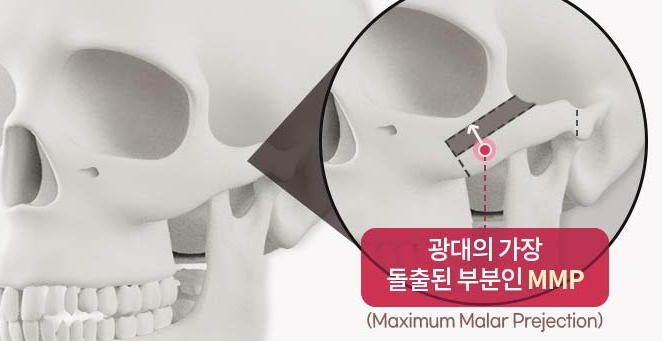 Key Points to Check Before Cheekbone Reduction Surgery image 2