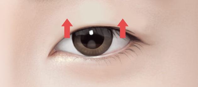 How Should Double Eyelid Surgery Be Performed for Protruding Eyes? image 3