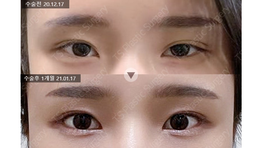 크고 시원한 눈매, 반드시 세미아웃라인이나 아웃라인이어야 할까요? 관련 이미지 2