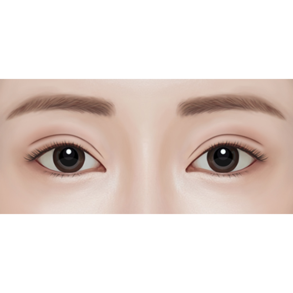 If You’re Worried About a Sausage-Like Double Eyelid, Check Whether the Hospital Is Good at Double-Line Method Revision Surgery image 1