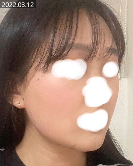 PureCell Fat Grafting: Fat Refinement and Grafting Techniques image 5