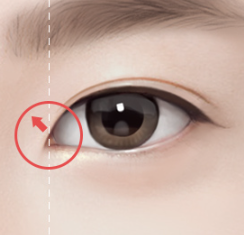눈매 개선을 위한 앞윗트임 수술, 어떤 변화가 있을까? 관련 이미지 4