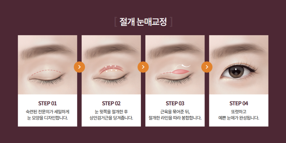 눈매교정 나에게 꼭 필요한 수술일까? 눈 상태에 따른 판단 기준 관련 이미지 4