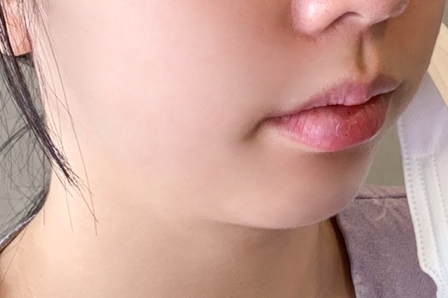 It Is Important to Perform Chin Augmentation with a Chin Implant by Considering Individual Facial Proportions image 3