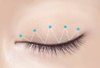 What Should You Check Before Undergoing a Non-Incisional Double Eyelid Surgery? image 4