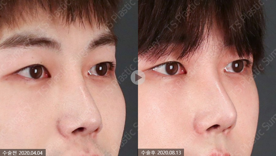The Key Is Naturalness! Rhinoplasty Completed with Autologous Tissue image 5