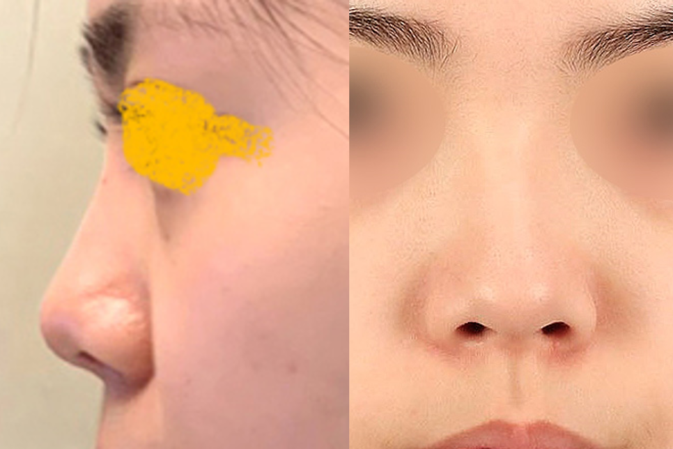[코수술 리뷰] 낮고 코끝이 들린 짧은코성형 케이스 리뷰 관련 이미지 1