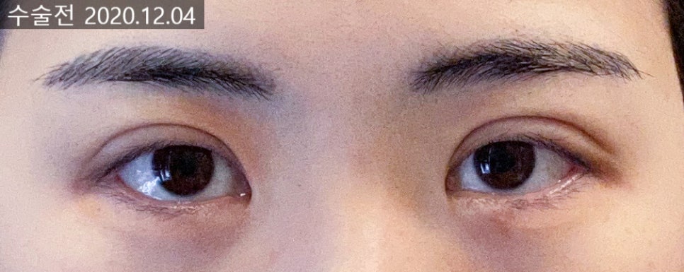 자연스러운 쌍꺼풀 라인 개선을 위한 방법 관련 이미지 3