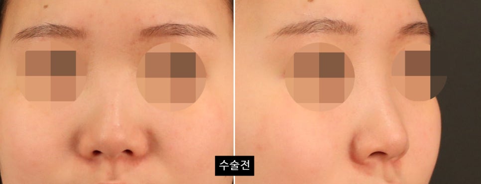 코수술 후 변화가 뚜렷하게 느껴지는 얼굴 유형 4가지 관련 이미지 7