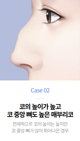 매부리코성형, 매부리 유형에 따라 수술 방향이 달라진다면? 관련 이미지 2