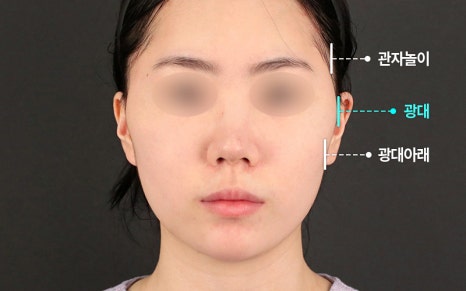 Does Facial Contouring Surgery Always Require All 3 Procedures? Cases Where Zygoma Reduction Surgery Alone Can Create a Smaller, Smoother Face image 2