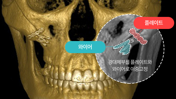 윤곽수술 알아본다면 균형 있는 얼굴형을 고려해 보세요 관련 이미지 2