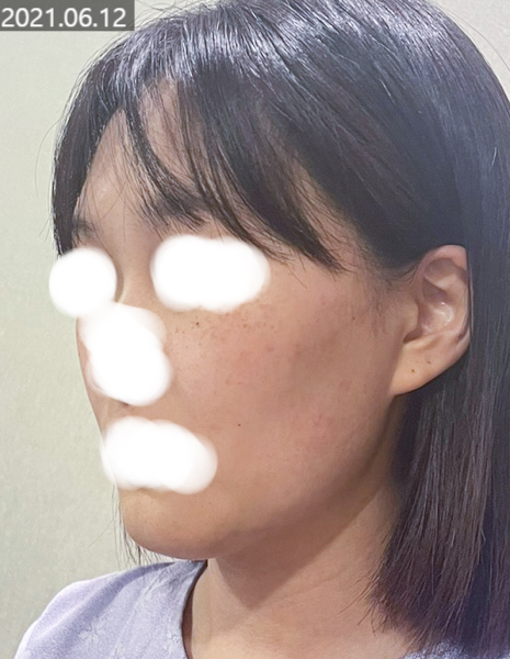 PureCell Fat Grafting: Fat Refinement and Grafting Techniques image 4