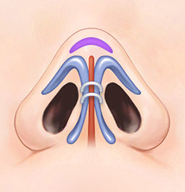 Natural Rhinoplasty That Refines the Nasal Tip with Ear Cartilage image 4