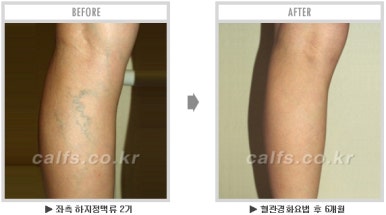 [두한성형외과 종아리수술] - [종아리성형 실패의 원인] 관련 이미지 8
