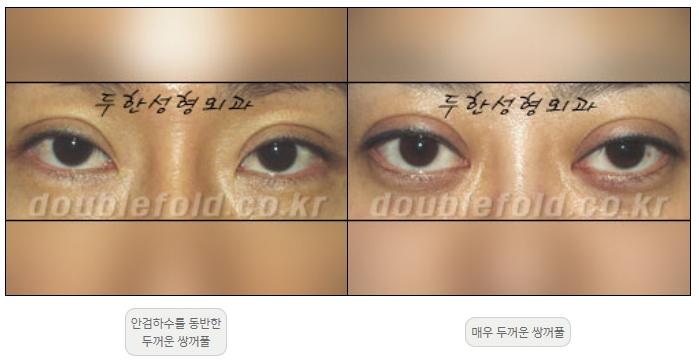 [Duhan Plastic Surgery Double Eyelid Revision] - [Thick Double Eyelid Line] image 1