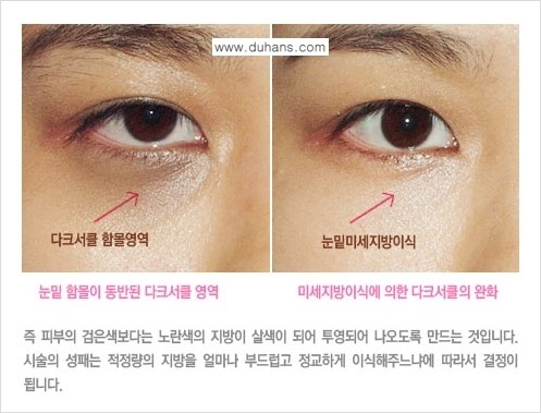 [두한성형외과 FOCUS 눈밑성형] - [다크써클의 치료방법 -  콜펫(Col-fat) 눈밑 미세지방이식 ⑤] 관련 이미지 4