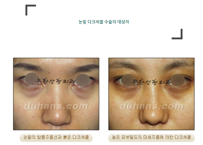 눈밑 다크써클 개선 원리 관련 이미지 1