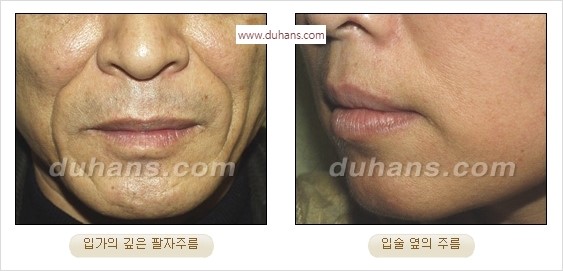 [두한성형외과 경쟁력 주름성형] - [간단하면서 자연스러운 주름제거 방법] 관련 이미지 2
