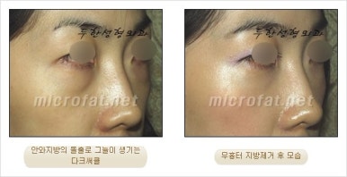 두한성형외과 눈밑수술 - 다크서클 수술 전후 관리 안내 관련 이미지 46