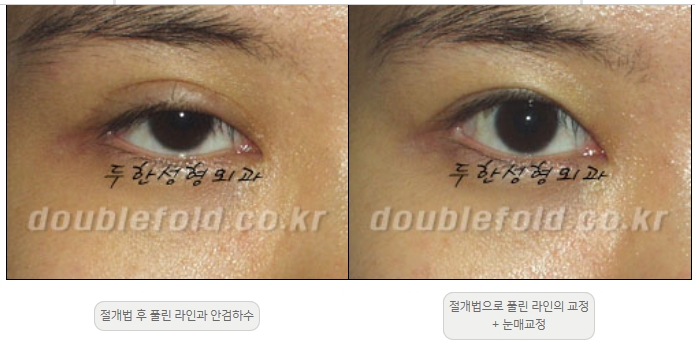 [두한성형외과 쌍커풀재수술] - [풀린 쌍커풀라인 교정] 관련 이미지 6