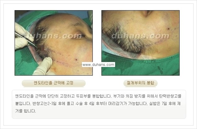 [두한성형외과 경쟁력 주름성형] - [주름제거 방법 안내] 관련 이미지 11