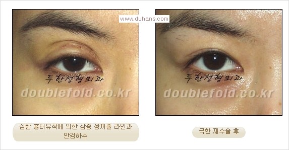 [두한성형외과 경쟁력 쌍꺼풀 재수술, 극한 재수술]- [쌍꺼풀 재수술의 성공 조건(Condition of successful reoperation) 관련 이미지 12
